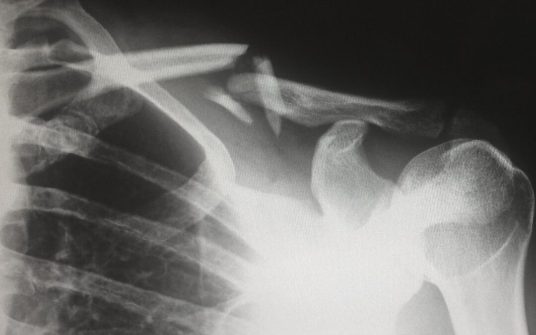 Can You File Personal Injury Claim Without a Lawyer?